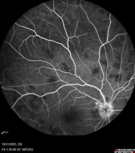 Serpiginous choroiditis in the right eye
68 year old female with spots in vision in the right eye for 2 months.  She has a history of MS.  The vision is 20/32 in both eyes.  She was treated with high dose steroids and transitioned to methotrexate and the right eye quieted  down.
