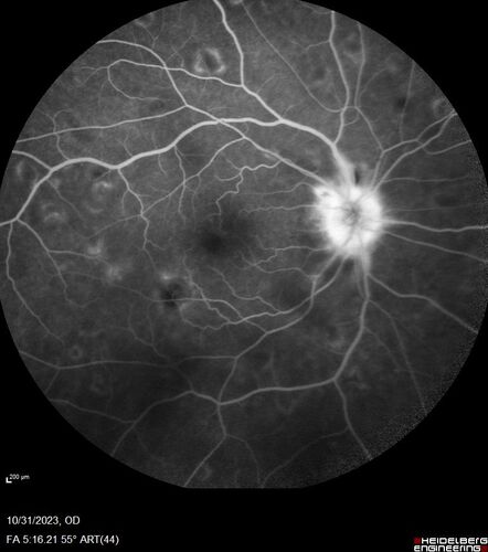 Serpiginous choroiditis in the right eye
68 year old female with spots in vision in the right eye for 2 months.  She has a history of MS.  The vision is 20/32 in both eyes.  She was treated with high dose steroids and transitioned to methotrexate and the right eye quieted  down.
