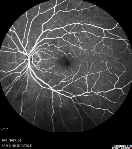 Serpiginous choroiditis in the right eye
68 year old female with spots in vision in the right eye for 2 months.  She has a history of MS.  The vision is 20/32 in both eyes.  She was treated with high dose steroids and transitioned to methotrexate and the right eye quieted  down.

