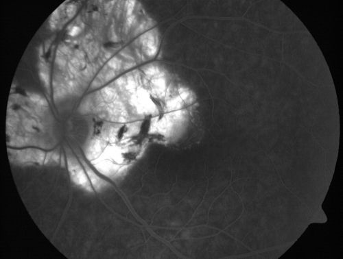 Serpiginous choroiditis
Inactive scars in both eyes
