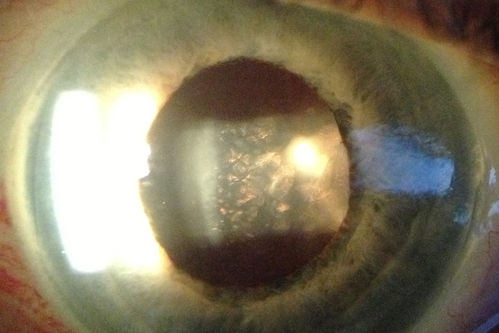 Grade B Proliferative Vitreo-retinopathy - Pigment in Anterior Vitreous - Chronic Retinal Detachment
72 year old woman - just noticed vision loss.
