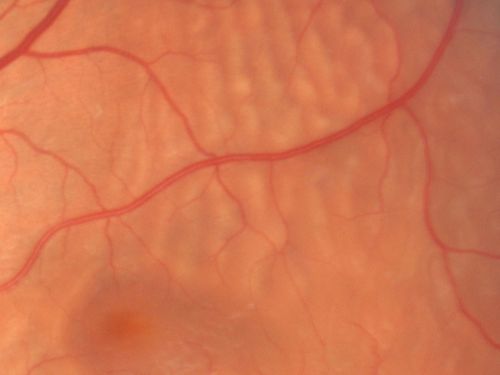 Recurrent Macula Off Retinal Detachment - Corrugated Shallow Appearance

