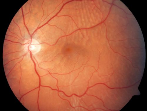 Recurrent Macula Off Retinal Detachment - Corrugated Shallow Appearance
62-year-old man shadow a week ago.  

VISUAL ACUITY:  Vision OS is 20/60. 	RECURRENT RETINAL DETACHMENT
