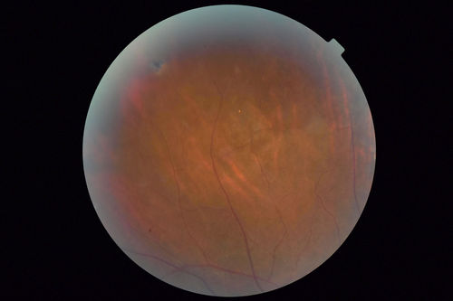 Sickle Retinopathy - Chronic retinal detachment OS - Proliferation OD
40 year old with known SC disease.  Failed to return 4 years ago for treatment and lost ision in the left eye.  Then returned for one visit and refused further treatment.
