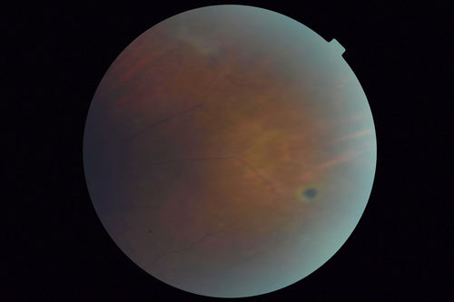Sickle Retinopathy - Chronic retinal detachment OS - Proliferation OD
40 year old with known SC disease.  Failed to return 4 years ago for treatment and lost ision in the left eye.  Then returned for one visit and refused further treatment.
