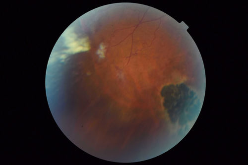 Sickle Retinopathy - Chronic retinal detachment OS - Proliferation OD
40 year old with known SC disease.  Failed to return 4 years ago for treatment and lost ision in the left eye.  Then returned for one visit and refused further treatment.
