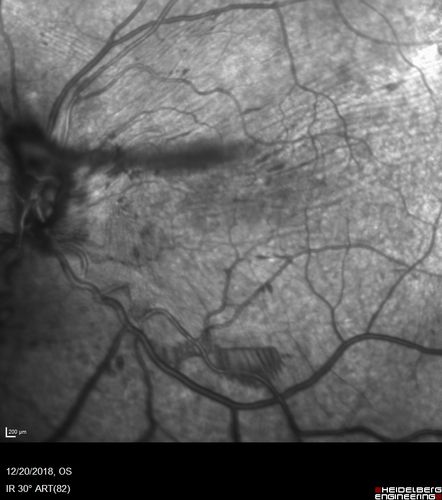 Sickle Retinopathy - Chronic retinal detachment OS - Proliferation OD
40 year old with known SC disease.  Failed to return 4 years ago for treatment and lost ision in the left eye.  Then returned for one visit and refused further treatment.
