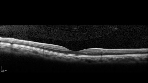 Sickle Retinopathy - Chronic retinal detachment OS - Proliferation OD
40 year old with known SC disease.  Failed to return 4 years ago for treatment and lost ision in the left eye.  Then returned for one visit and refused further treatment.
