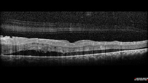 Sickle Retinopathy - Chronic retinal detachment OS - Proliferation OD
40 year old with known SC disease.  Failed to return 4 years ago for treatment and lost ision in the left eye.  Then returned for one visit and refused further treatment.
