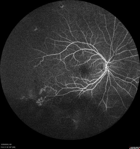 Sickle Retinopathy - Chronic retinal detachment OS - Proliferation OD
40 year old with known SC disease.  Failed to return 4 years ago for treatment and lost ision in the left eye.  Then returned for one visit and refused further treatment.
