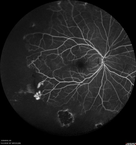 Sickle Retinopathy - Chronic retinal detachment OS - Proliferation OD
40 year old with known SC disease.  Failed to return 4 years ago for treatment and lost ision in the left eye.  Then returned for one visit and refused further treatment.
