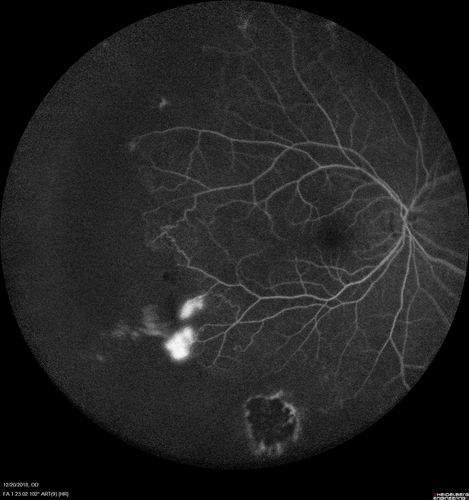 Sickle Retinopathy - Chronic retinal detachment OS - Proliferation OD
40 year old with known SC disease.  Failed to return 4 years ago for treatment and lost ision in the left eye.  Then returned for one visit and refused further treatment.
