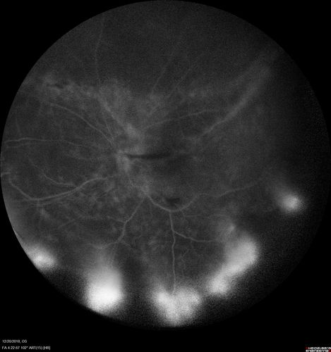 Sickle Retinopathy - Chronic retinal detachment OS - Proliferation OD
40 year old with known SC disease.  Failed to return 4 years ago for treatment and lost ision in the left eye.  Then returned for one visit and refused further treatment.
