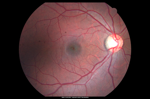 Sickle Retinpoathy SC Disease - Vitreous Hemorrhage Left Eye - 29 Year old
