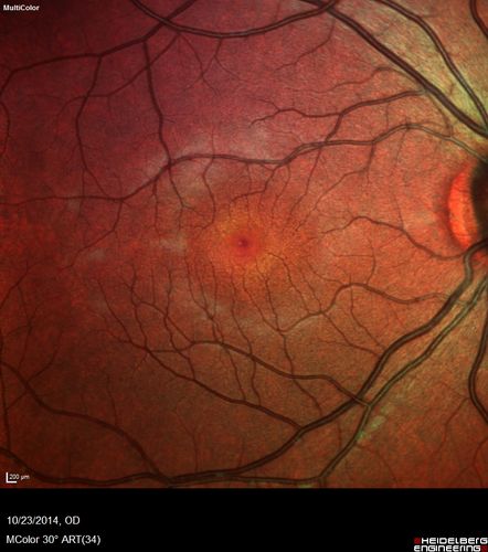 Sickle Retinpoathy SC Disease - Vitreous Hemorrhage Left Eye - 29 Year old
