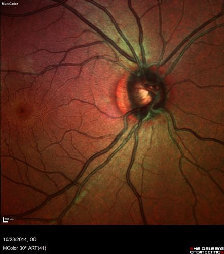 Sickle Retinpoathy SC Disease - Vitreous Hemorrhage Left Eye - 29 Year old
