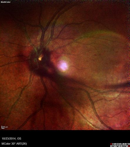 Sickle Retinpoathy SC Disease - Vitreous Hemorrhage Left Eye - 29 Year old
