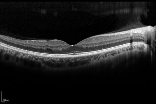 Sickle Retinpoathy SC Disease - Vitreous Hemorrhage Left Eye - 29 Year old
