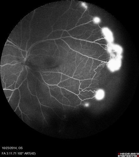 Sickle Retinopathy - Ultra Wide Field Angiogram - Heidelberg
Leakage from peripheral fronds of NV - HGB SC disease - 28 year old man with vision loss OS from acute vitreous hemorrhage
