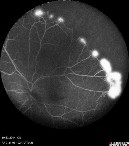 Sickle Retinopathy - Ultra Wide Field Angiogram - Heidelberg
Leakage from peripheral fronds of NV - HGB SC disease - 28 year old man with vision loss OS from acute vitreous hemorrhage

