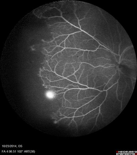 Sickle Retinopathy - Ultra Wide Field Angiogram - Heidelberg
Leakage from peripheral fronds of NV - HGB SC disease - 28 year old man with vision loss OS from acute vitreous hemorrhage
