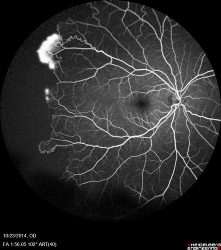 Sickle Retinopathy - Ultra Wide Field Angiogram - Heidelberg
Leakage from peripheral fronds of NV - HGB SC disease - 28 year old man with vision loss OS from acute vitreous hemorrhage
