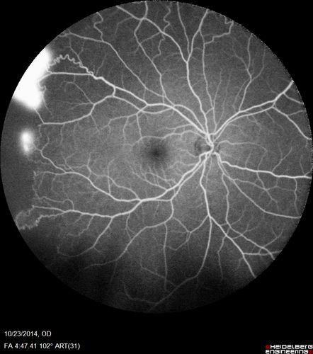 Sickle Retinopathy - Ultra Wide Field Angiogram - Heidelberg
Leakage from peripheral fronds of NV - HGB SC disease - 28 year old man with vision loss OS from acute vitreous hemorrhage
