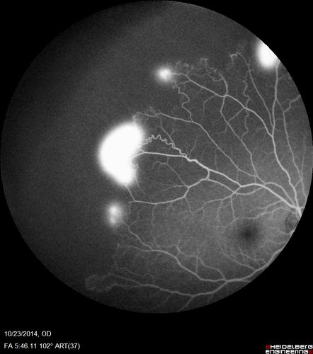 Sickle Retinopathy - Ultra Wide Field Angiogram - Heidelberg
Leakage from peripheral fronds of NV - HGB SC disease - 28 year old man with vision loss OS from acute vitreous hemorrhage
