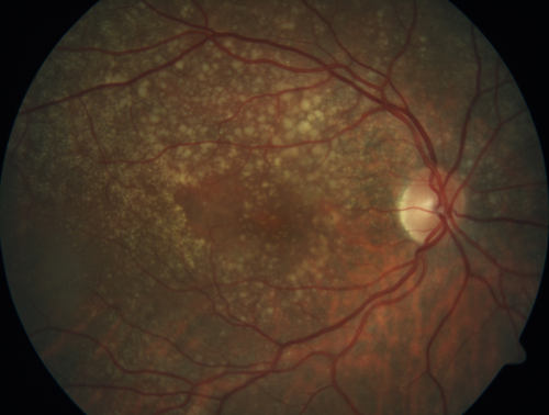 Soft Drusen
63 year old female with 20/16 vision both eyes
