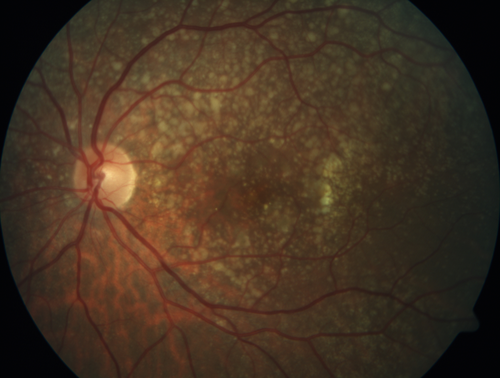 Soft Drusen
63 year old female with 20/16 vision both eyes
