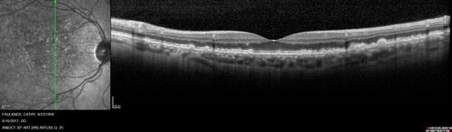 Soft Drusen
63 year old female with 20/16 vision both eyes
