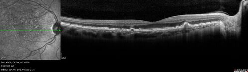 Soft Drusen
63 year old female with 20/16 vision both eyes
