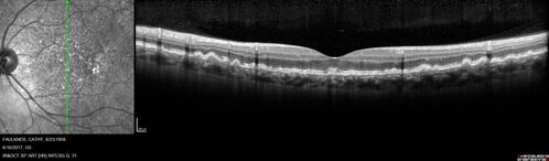 Soft Drusen
63 year old female with 20/16 vision both eyes
