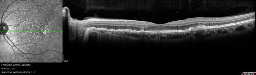 Soft Drusen
63 year old female with 20/16 vision both eyes
