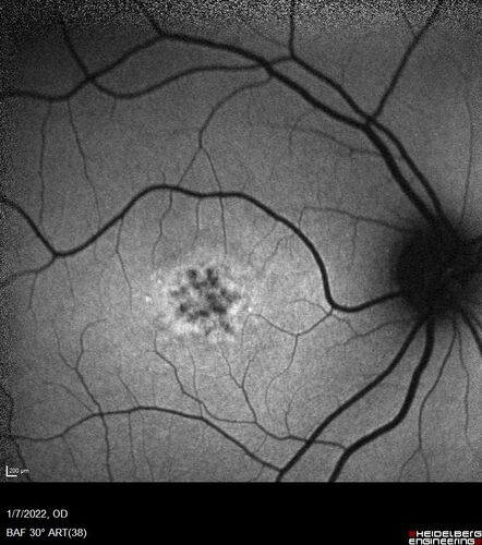 25 year old with Stargard and 2 ABCA4 mutations.
She has worn glasses since she was a kid.  Since she became an adult her vision started to deteriorate more rapidly.  This seems to have been happening since she entered the accounting department for the last two years.  Her vision is worse in the light especially when she is driving.  She can see green lights in the night but not in the day.  She sees better on a dark background than on a light background.  Her mom is genetically visually impaired with Stargardts.  Her father has RP.  The mother was genetically tested in Boston about 23 years ago.  That was when the gene was first being isolated. (The mother has seven brothers and sisters and four have stargardts and they are legally blind.  Also one cousin has it.)
VA OD: Dcc20/160-1 PH20/80 Ncc20/200-2
VA OS: Dcc20/160-2 PH20/80-1 Ncc20/200-1
IOP: TP: OD:20 OS:21
