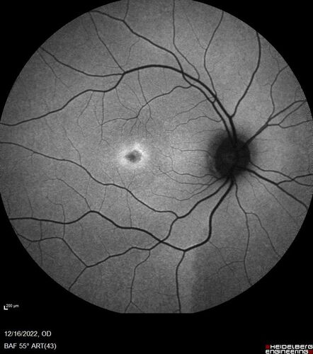 Stargardt Disease - Very Mild - 24 year old
This patient has 3 different ABCA4 mutations.  His mother and sister have stargardts and his father has RP.  His sisters images are also on Retinagallery.com

