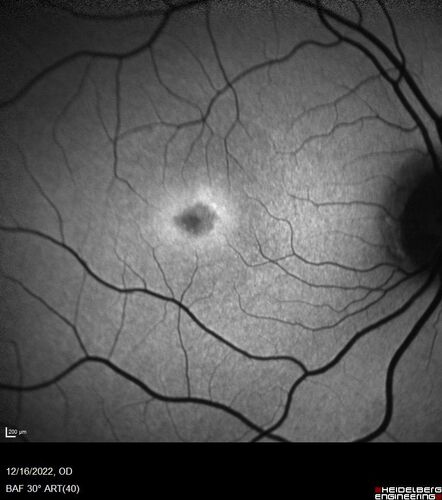 Stargardt Disease - Very Mild - 24 year old
This patient has 3 different ABCA4 mutations.  His mother and sister have stargardts and his father has RP.  His sisters images are also on Retinagallery.com
