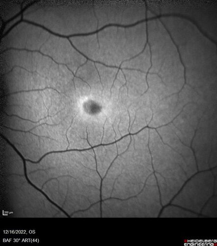 Stargardt Disease - Very Mild - 24 year old
This patient has 3 different ABCA4 mutations.  His mother and sister have stargardts and his father has RP.  His sisters images are also on Retinagallery.com
