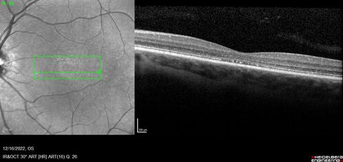 Stargardt Disease - Very Mild - 24 year old
This patient has 3 different ABCA4 mutations.  His mother and sister have stargardts and his father has RP.  His sisters images are also on Retinagallery.com
