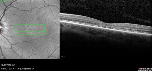 Stargardt Disease - Very Mild - 24 year old
This patient has 3 different ABCA4 mutations.  His mother and sister have stargardts and his father has RP.  His sisters images are also on Retinagallery.com
