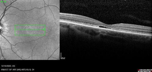 Stargardt Disease - Very Mild - 24 year old
This patient has 3 different ABCA4 mutations.  His mother and sister have stargardts and his father has RP.  His sisters images are also on Retinagallery.com
