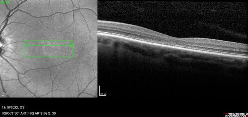 Stargardt Disease - Very Mild - 24 year old
This patient has 3 different ABCA4 mutations.  His mother and sister have stargardts and his father has RP.  His sisters images are also on Retinagallery.com
