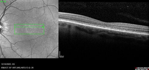 Stargardt Disease - Very Mild - 24 year old
This patient has 3 different ABCA4 mutations.  His mother and sister have stargardts and his father has RP.  His sisters images are also on Retinagallery.com
