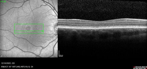 Stargardt Disease - Very Mild - 24 year old
This patient has 3 different ABCA4 mutations.  His mother and sister have stargardts and his father has RP.  His sisters images are also on Retinagallery.com
