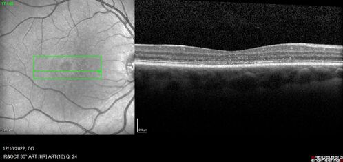 Stargardt Disease - Very Mild - 24 year old
This patient has 3 different ABCA4 mutations.  His mother and sister have stargardts and his father has RP.  His sisters images are also on Retinagallery.com
