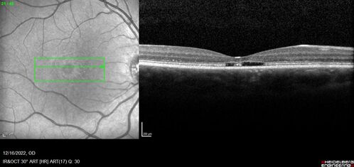 Stargardt Disease - Very Mild - 24 year old
This patient has 3 different ABCA4 mutations.  His mother and sister have stargardts and his father has RP.  His sisters images are also on Retinagallery.com
