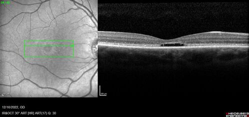 Stargardt Disease - Very Mild - 24 year old
This patient has 3 different ABCA4 mutations.  His mother and sister have stargardts and his father has RP.  His sisters images are also on Retinagallery.com
