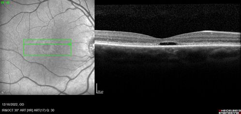 Stargardt Disease - Very Mild - 24 year old
This patient has 3 different ABCA4 mutations.  His mother and sister have stargardts and his father has RP.  His sisters images are also on Retinagallery.com
