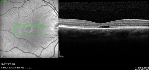 Stargardt Disease - Very Mild - 24 year old
This patient has 3 different ABCA4 mutations.  His mother and sister have stargardts and his father has RP.  His sisters images are also on Retinagallery.com
