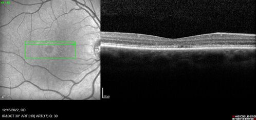 Stargardt Disease - Very Mild - 24 year old
This patient has 3 different ABCA4 mutations.  His mother and sister have stargardts and his father has RP.  His sisters images are also on Retinagallery.com
